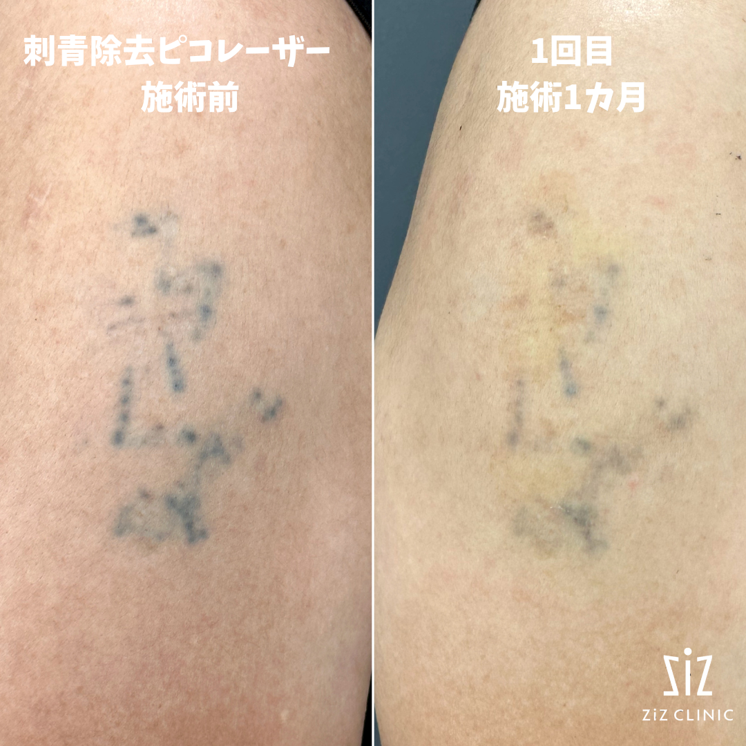 素人　tatto 素人彫り』を除去したい - タトゥー除去専門の美容クリニック ziz CLINIC ―ジズクリニック―