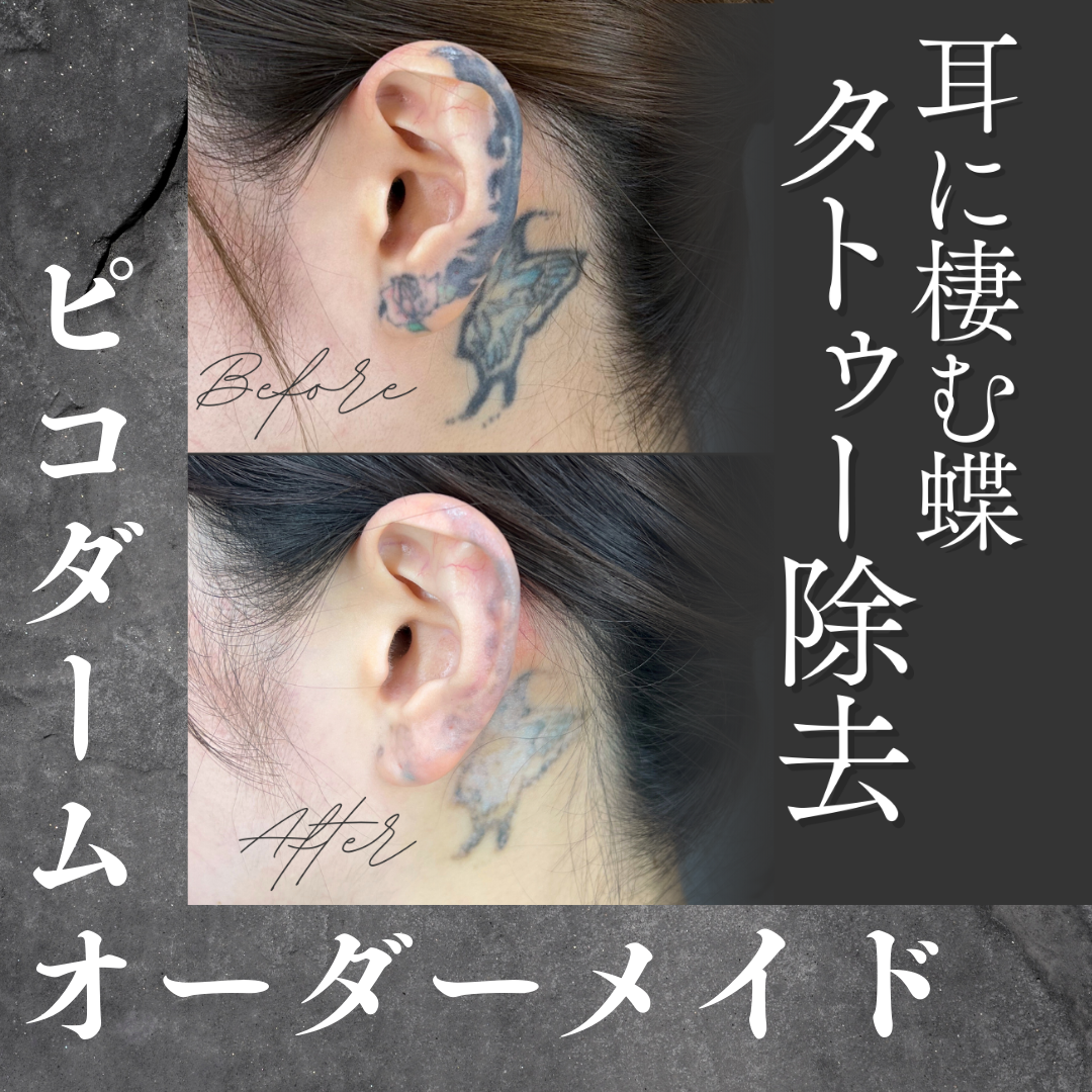 耳 アーカイブ - タトゥー除去専門の美容クリニック ziz CLINIC ―ジズ 