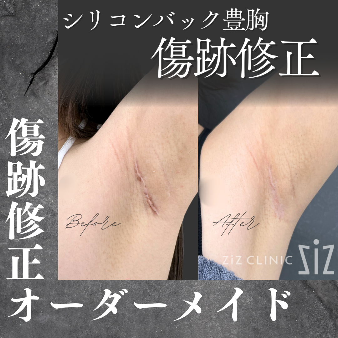 乳房下縁切開のシリコンバック豊胸 傷跡修正オーダーメイド 1回目 施術1週間 - タトゥー除去専門の美容クリニック ziz CLINIC ―ジ ...