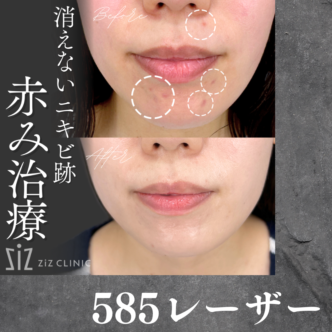 リストカット跡の傷跡修正 - キレイに消すなら傷跡専門の美容クリニック